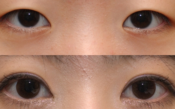 上海哪家醫(yī)院做眼袋手術(shù)價格實惠又靠譜？排行榜前十強！