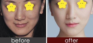 有效消腫的雙眼皮修復(fù)技巧由經(jīng)驗(yàn)豐富的整形醫(yī)生分享 有效消腫的雙眼皮修復(fù)技巧由經(jīng)驗(yàn)豐富的整形醫(yī)生分享