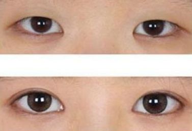 揚州陳嘯醫(yī)生的雙眼皮手術(shù)功力與成功案例分享 揚州陳嘯醫(yī)生的雙眼皮手術(shù)功力與成功案例分享