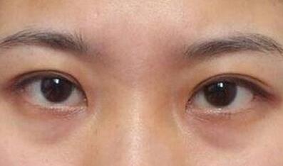 杭州東方整形吸脂到底值不值得嘗試？