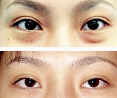 謝錦清：醫(yī)術(shù)高超，雙眼皮案例解析曝光！
