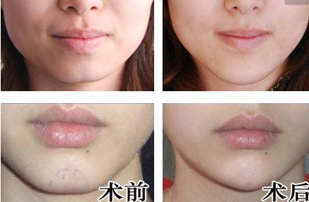 廣州人中縮短手術(shù)醫(yī)生推薦？網(wǎng)友真實評價與信息公開！