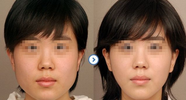 成都隆鼻醫(yī)生排行榜2024：專家推薦的醫(yī)院大揭秘！