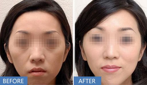 上海哪家醫(yī)院做打玻尿酸除皺效果好？