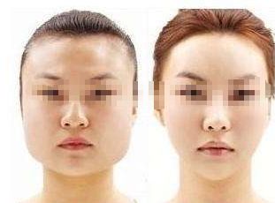 告別痘痘困擾，打造光彩肌膚