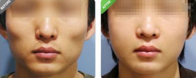 深圳哪家醫(yī)院的拉皮除皺效果最好？排名前幾位的醫(yī)院有哪些？