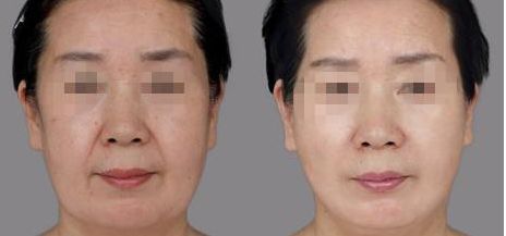 樂山哪家整形醫(yī)院雙眼皮比較好？匯總單六強(qiáng)預(yù)測(cè)