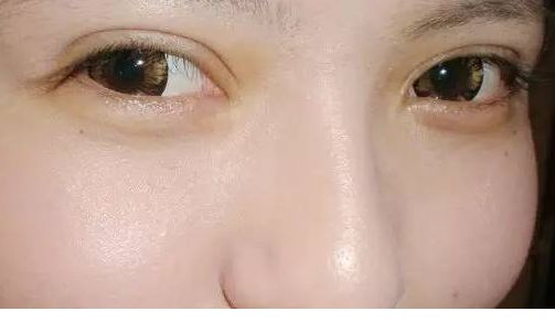 面對(duì)魚尾紋問題，該怎么辦？
