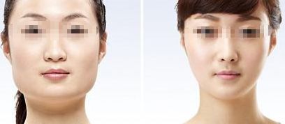 咸陽哪家醫(yī)院做雙眼皮好？醫(yī)院推薦！