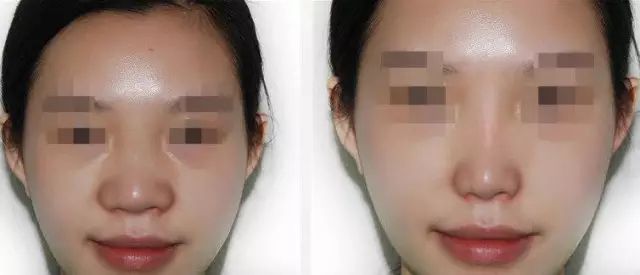 哈爾濱哪家醫(yī)院做隆鼻好？醫(yī)療技術(shù)排行幫你快速選擇