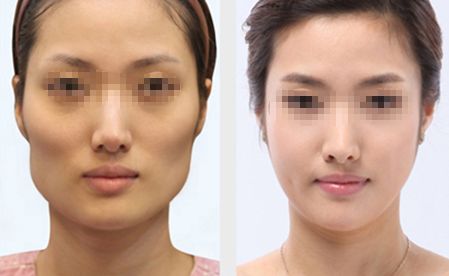 深圳隆胸醫(yī)院推薦：專業(yè)經(jīng)驗豐富、口碑好的醫(yī)院