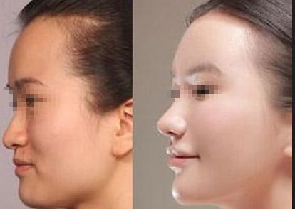 成都恒博植發(fā)效果如何？真實(shí)案例分享與價(jià)格分析