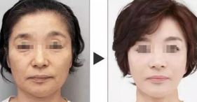 西安哪家醫(yī)院擅長面部輪廓整形？