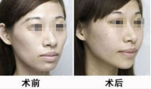 拉皮整形選擇趙絳波，打造無(wú)痕美顏，見(jiàn)證真實(shí)效果