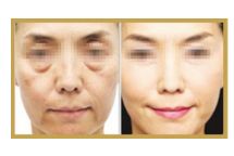 日照哪家醫(yī)院做雙眼皮手術(shù)技術(shù)高效？