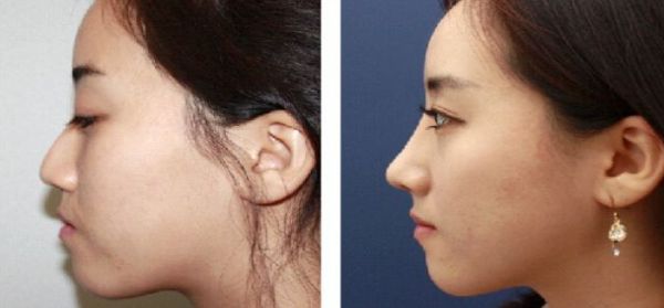 北京大腿抽脂專(zhuān)家推薦，哪個(gè)醫(yī)院技術(shù)好？