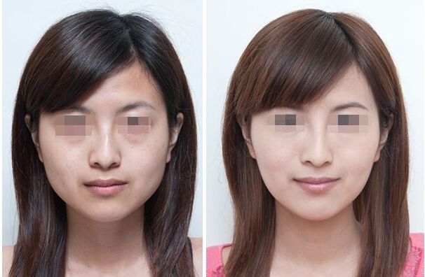 合肥哪家雙眼皮修復效果好？排名前十的整形醫(yī)院大揭秘