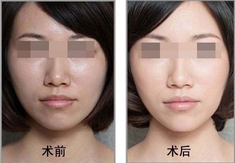 佛山哪家整形醫(yī)院是喬雅登個人推薦的Top7 佛山哪家整形醫(yī)院是喬雅登個人推薦的Top7