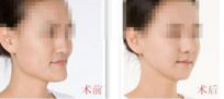 成都哪家醫(yī)院做自體豐胸效果更好？