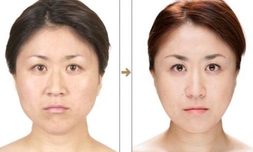 上海美聯(lián)臣吸脂怎么樣？真實案例告訴你答案！