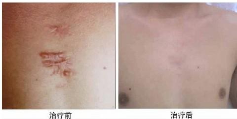 長(zhǎng)沙微整形祛疤祛痘醫(yī)生