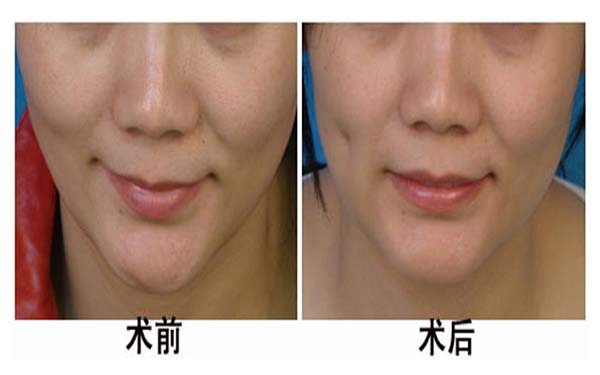 湖州雙眼皮手術(shù)機(jī)構(gòu)推薦：3家優(yōu)質(zhì)醫(yī)院完美整形，放心選擇