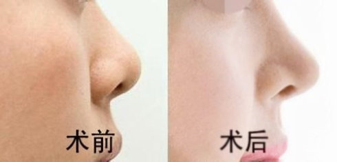 重慶現(xiàn)在有哪些當代鼻子整形醫(yī)生值得關(guān)注？參考謝錦清和曾高醫(yī)生的口碑評價