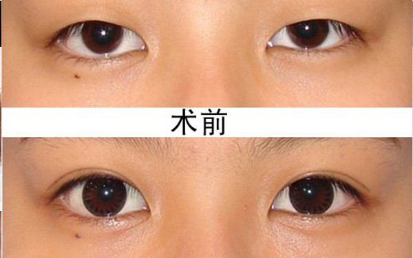 2023西安鼻基骨縮窄手術(shù)醫(yī)院排名前10強(qiáng)，值得信賴的口碑推薦！