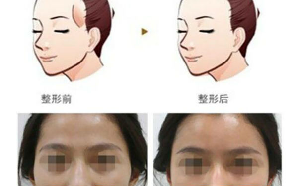 洛陽哪家醫(yī)院做木偶紋效果好？2023榜單出爐，洛陽物理去木偶紋top10佳選露面！