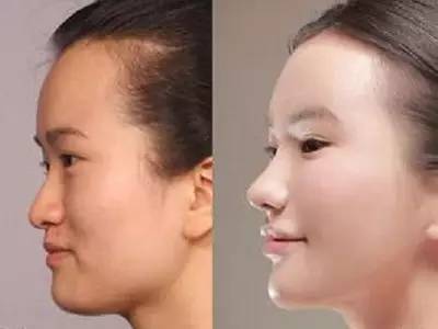2023年，哪些上海自體脂肪面部精雕整形醫(yī)院的口碑特別好？排名榜前十值得信賴的美容整形醫(yī)院！
