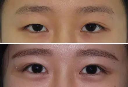 杭州駝峰鼻矯正哪家整形醫(yī)院技術(shù)獨(dú)特？2023杭州駝峰鼻矯正排名前10的醫(yī)院評測揭曉！