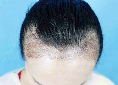 宜賓市哪家整形醫(yī)院專業(yè)豐額頭術(shù)效果好？探尋宜賓自體脂肪豐額頭術(shù)醫(yī)院口碑佳！2023宜賓豐額頭術(shù)推薦前十技