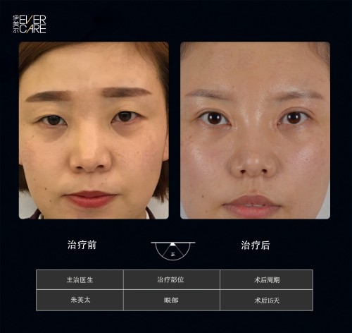 阿爾法9°美眼，打開視界，美無止境