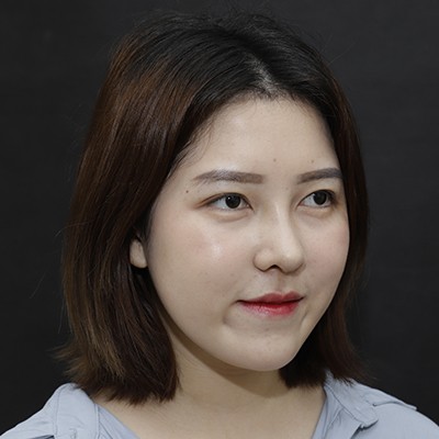 廣州美恩半肋鼻手術(shù)恢復(fù)效果反饋，主任親自操刀的效果就是贊！