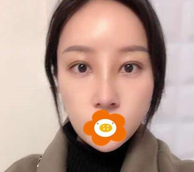 鄭州禾麗做肋軟骨隆鼻術(shù)后兩個月效果