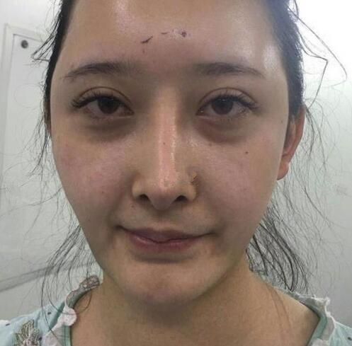 深圳陽光全臉填充術前術后對比，說年輕十歲不過分吧