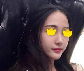 塌鼻子小妹在深圳鵬愛(ài)做隆鼻手術(shù)，三個(gè)月后竟然是這樣的