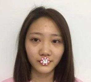 北京彤美耳軟骨隆鼻三個(gè)月效果分享，吐血推薦