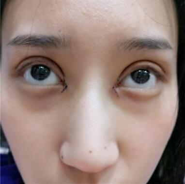 雙眼皮失敗丑的不敢見人，昆明麗都整形雙眼皮修復(fù)案例分享