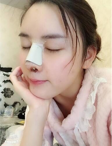 北京哪家隆鼻好？花一萬鼻子做成這樣值不值