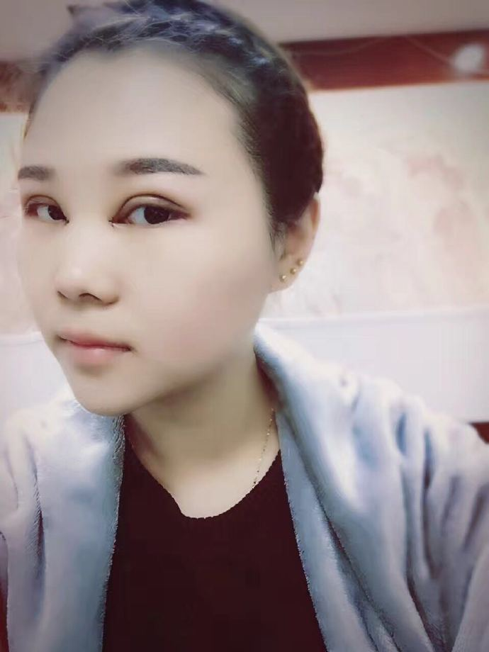 腫眼泡應(yīng)該做哪種雙眼皮？汕頭曙光雙眼皮三個月效果分享