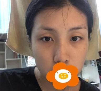 救命，周杰群做的耳軟骨隆鼻恢復(fù)后鼻背線條也太好看了吧