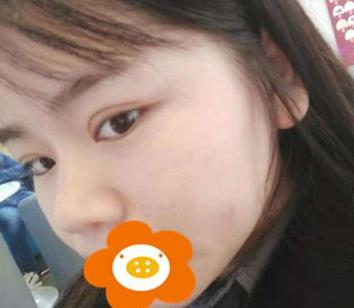 據(jù)說(shuō)杭州薇琳隆鼻后效果很自然，有案例嗎