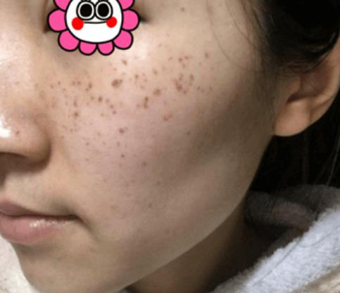 困惱我多年的斑，沒想到在溫州韓美三千塊錢就去掉了