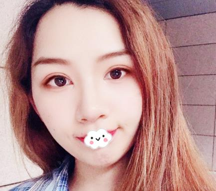 武漢伊萊美割雙眼皮怎么樣？切開雙眼皮恢復過程圖