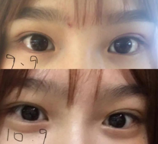 做雙眼皮案例，濟(jì)南坤如瑪麗崔金珍雙眼皮案例圖片
