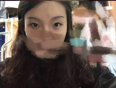 做雙眼皮案例，北京藝星張順慶雙眼皮案例圖片