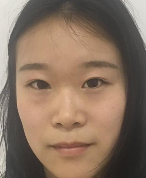 石家莊諾萬整形肋軟骨隆鼻案例分享，恢復過程圖