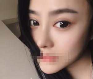 親身經(jīng)驗(yàn)，重慶星范整形的超體隆鼻真的很自然