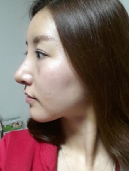武漢中翰整形駝峰鼻矯正案例術(shù)后一個月效果